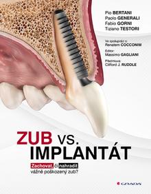 Kniha: Zub vs. implantát - Zachovat, či nahradit vážně poškozený zub? - Pio Bertani; Paolo Generali; Fabio Gorni; Tiziano Testori
