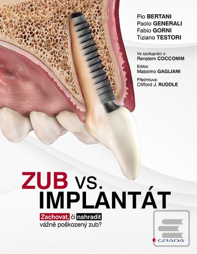 Kniha: Zub vs. implantát - Zachovat, či nahradit vážně poškozený zub? - Pio Bertani; Paolo Generali; Fabio Gorni; Tiziano Testori